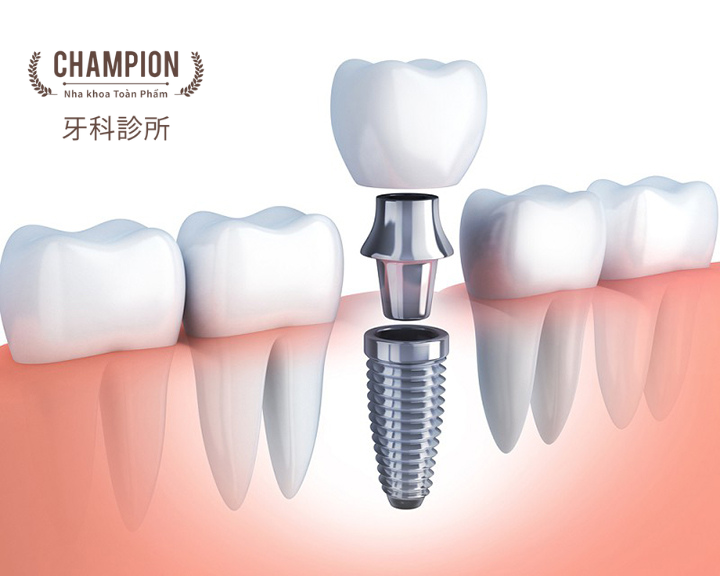 Cấy ghép Implant có an toàn không?